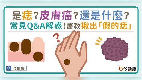 內痣是什麼|是痣？皮膚癌？還是什麼？常見Q&A解惑！醫教揪出「假的痣」